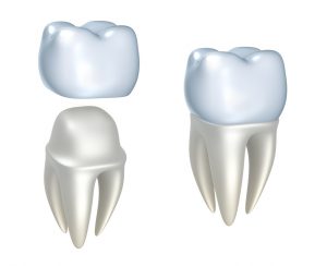 Dr. C. Gary Simmons, your dentist in Spring, TX gives you the info you need on the long-lasting nature of dental crowns. 